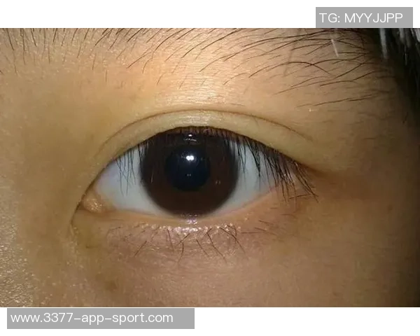 西媒揭示赫伊森眼睛难以睁开的原因是先天性眼睑下垂但不影响视力 西媒揭示赫伊森眼睛难以睁开的原因是先天性眼睑下垂但不影响视力